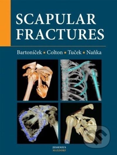 Scapular fractures - Jan Bartoníček, Michal Tuček, Ondřej Naňka - obrázek 1